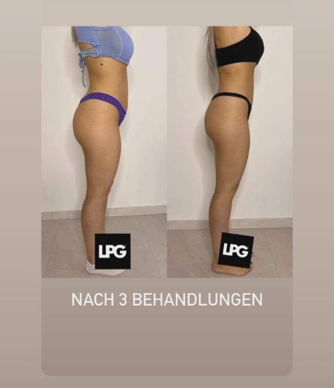 LPG Endermologie
